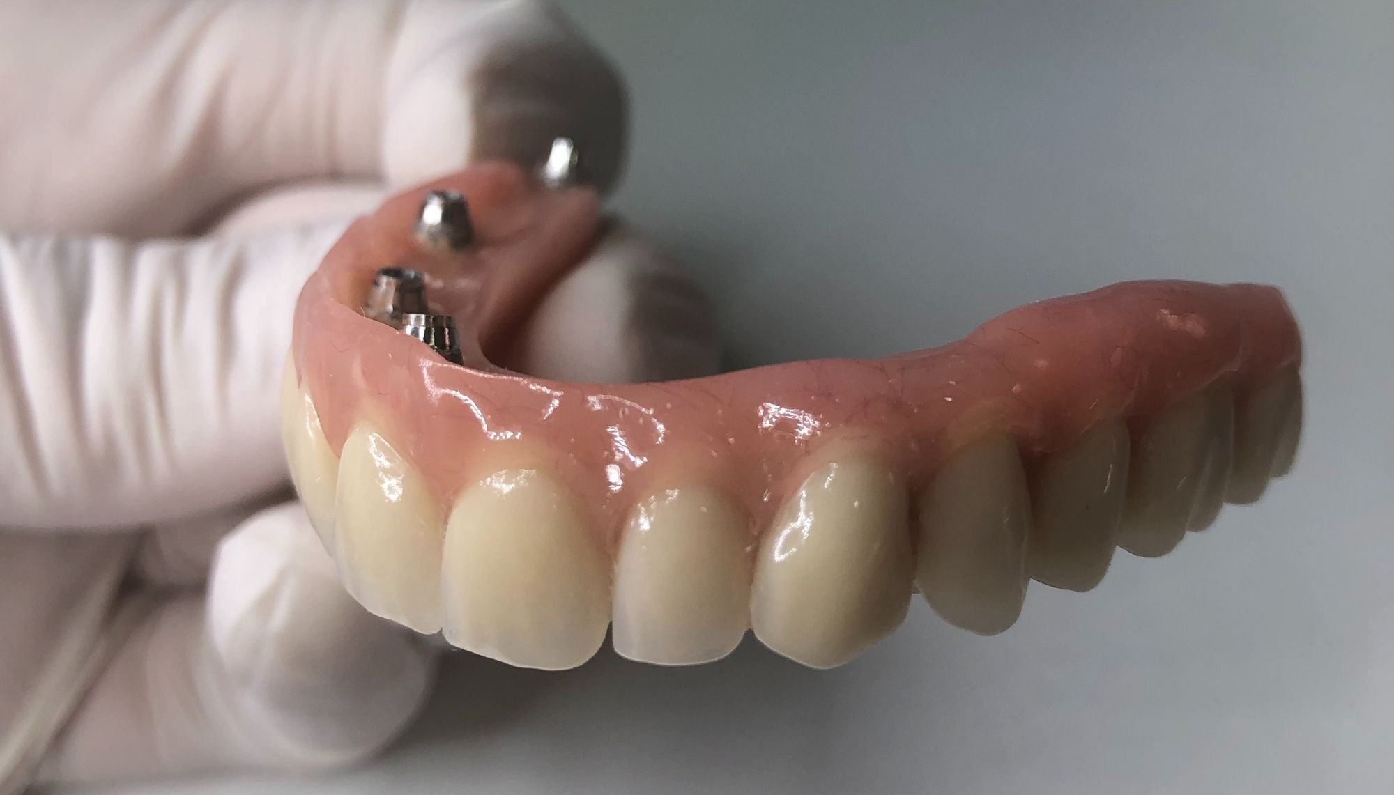 Híbrida de Resina - Prótesis Fijas | Laboratorio Dental Rebeca Giménez