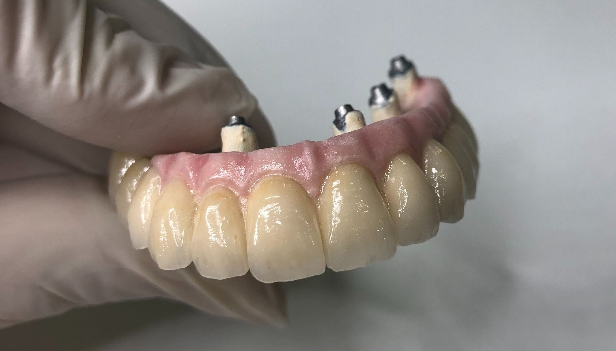 Metal Cerámica - Prótesis Dentales Fijas | Laboratorio Dental Rebeca Giménez