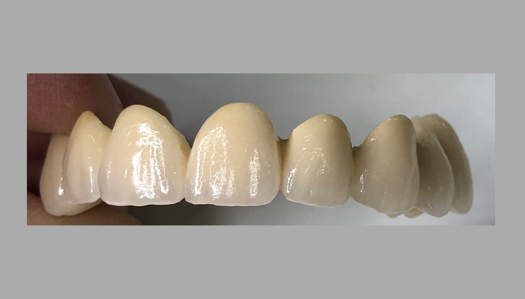 Prótesis Cemenada | Laboratorio Dental Rebeca Giménez