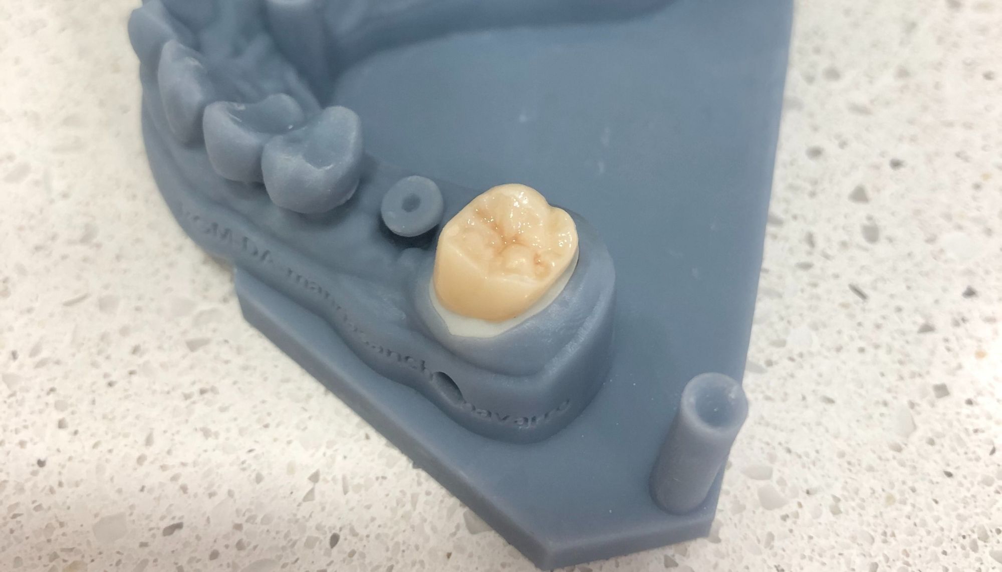 Sistema 3D - Corona Provisional | Laboratorio Dental Rebeca Giménez